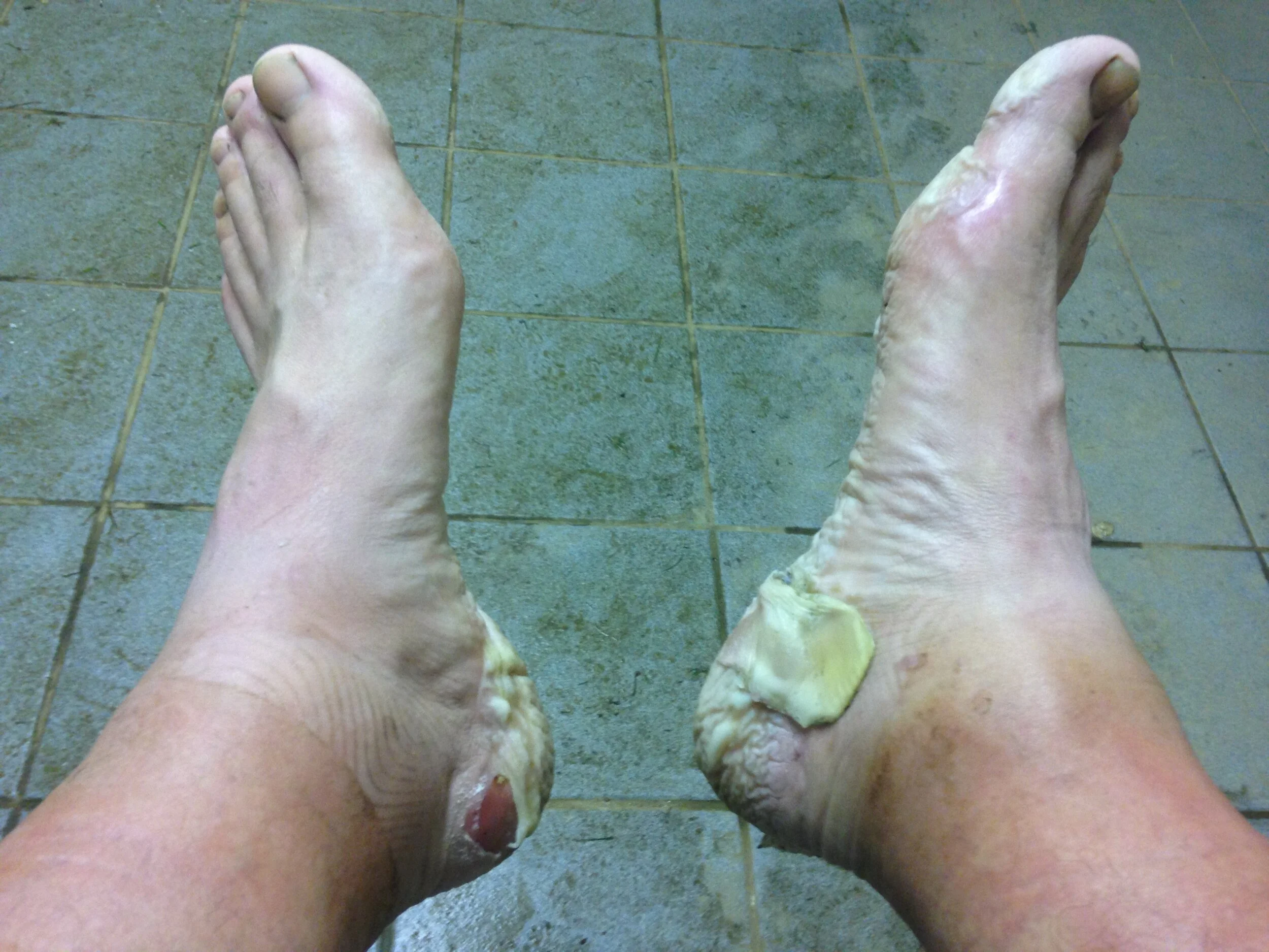 Bad blister shop on heel